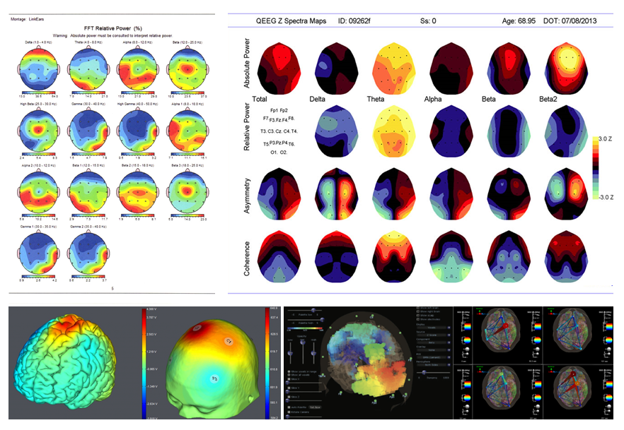 QEEG Or Quantitative EEG Brain Maps Is The First Step In Helping You 